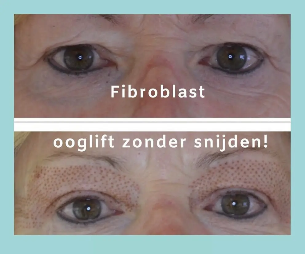 Fibrolast