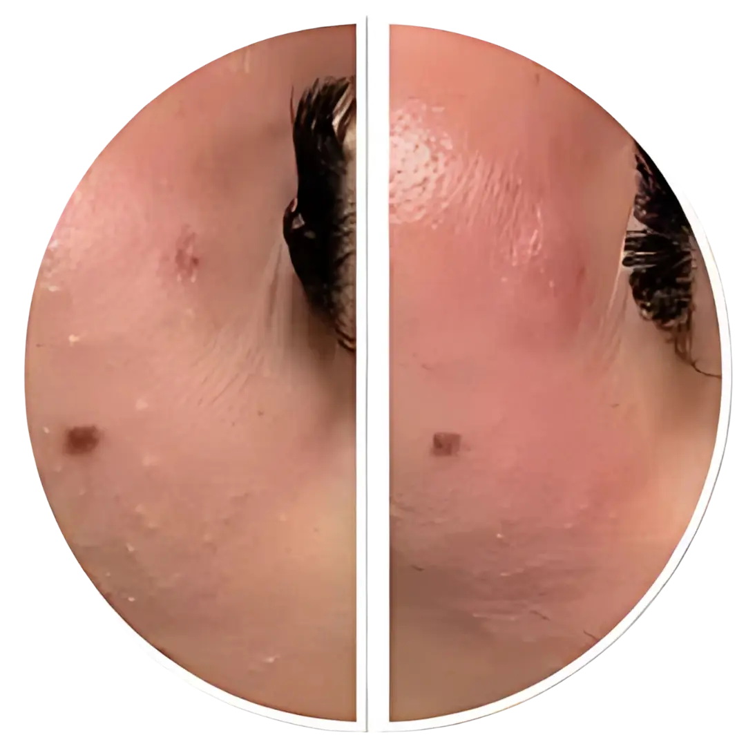 KTP couperose laser | Before & after