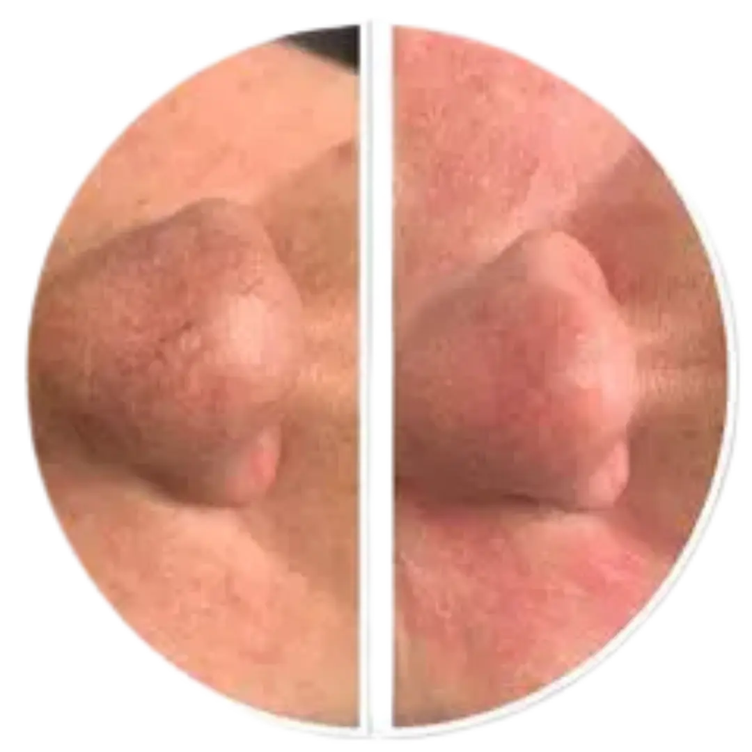 KTP couperose laser | Before & after