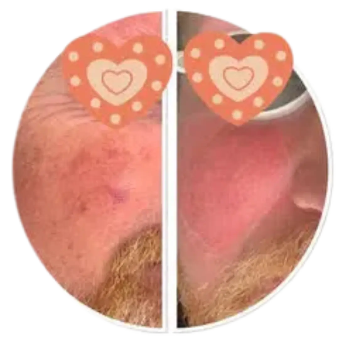 KTP couperose laser | Before & after